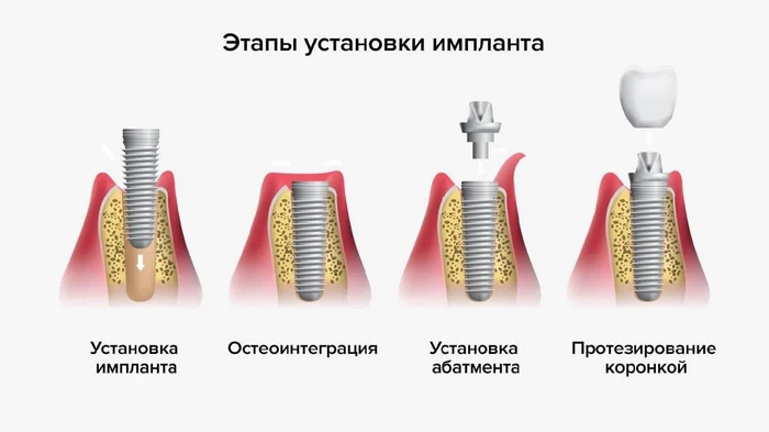fázy implantácie zubov