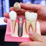 1747727774_pre-koho-su-vhodne-jednostupnove-zubne-implantaty.webp.webp